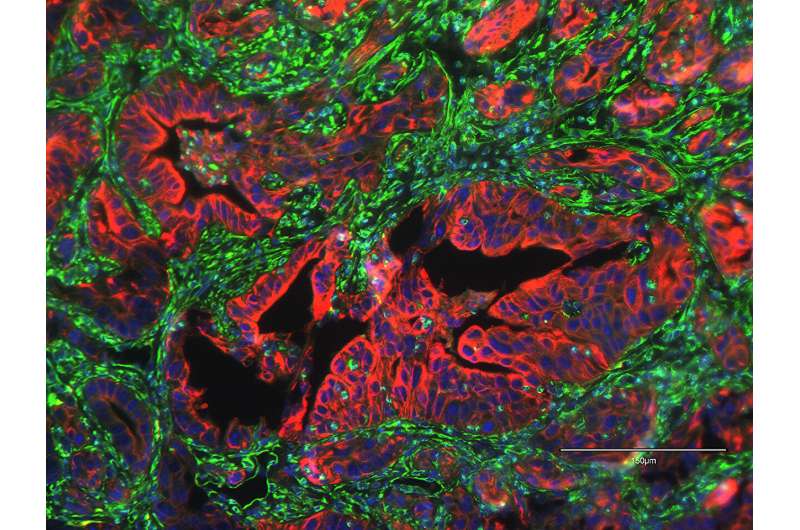 Researchers identify protein linked to metastasis in pancreatic cancer