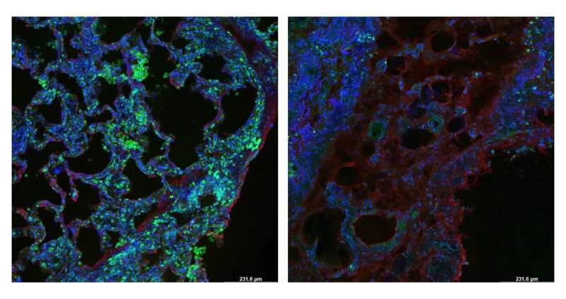 Researchers identify protein sensor that plays a role in lung fibrosis