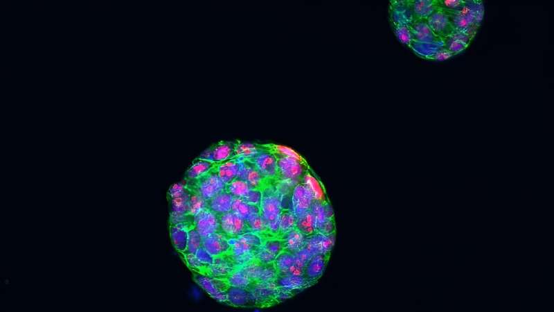 Researchers identify what drives PARP inhibitor resistance in advanced breast cancer