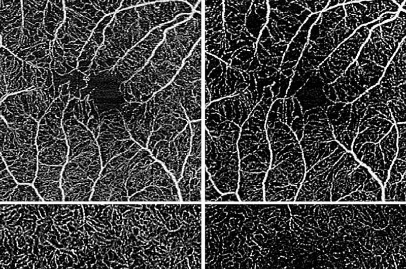 researchers test a new imaging method for monitoring rare eye disease intermediate uveitis