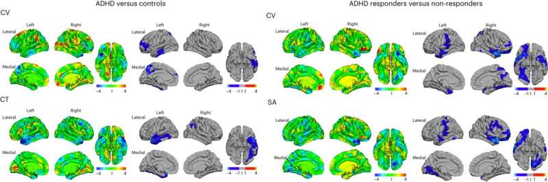 Responsiveness to ADHD treatment may be determined by neuroanatomy