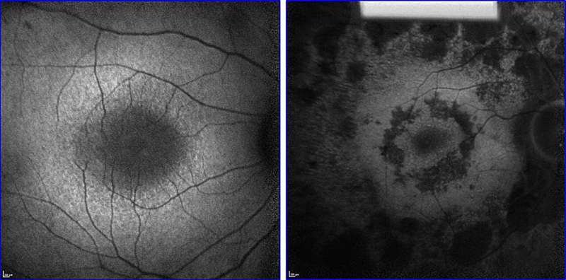 Revitalizing vision: Metabolome rejuvenation slows retinal degeneration