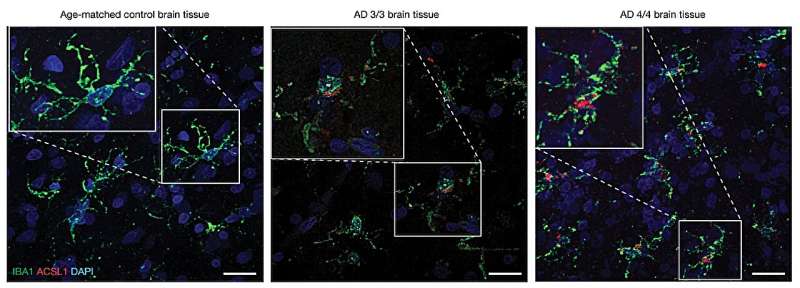 Root cause of Alzheimer's may be fat buildup in brain cells