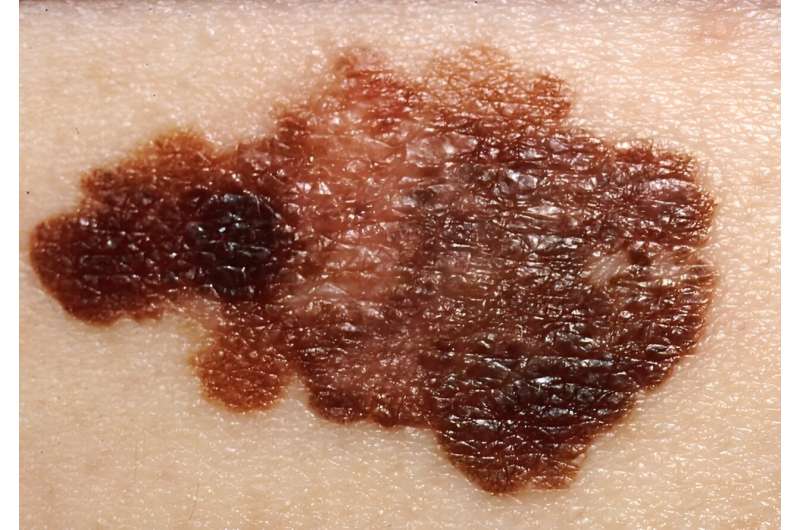 Sarah Ferguson diagnosed with malignant melanoma. Here are the latest treatments