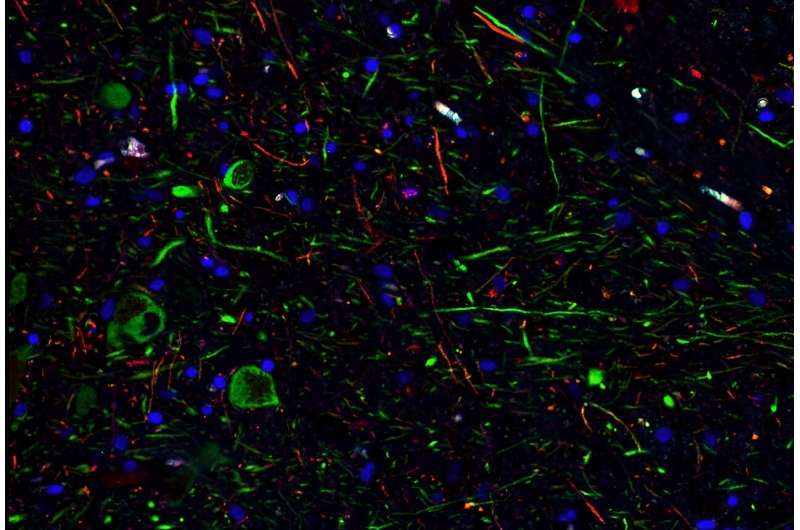 SARS-CoV-2 can infect dopamine neurons causing senescence