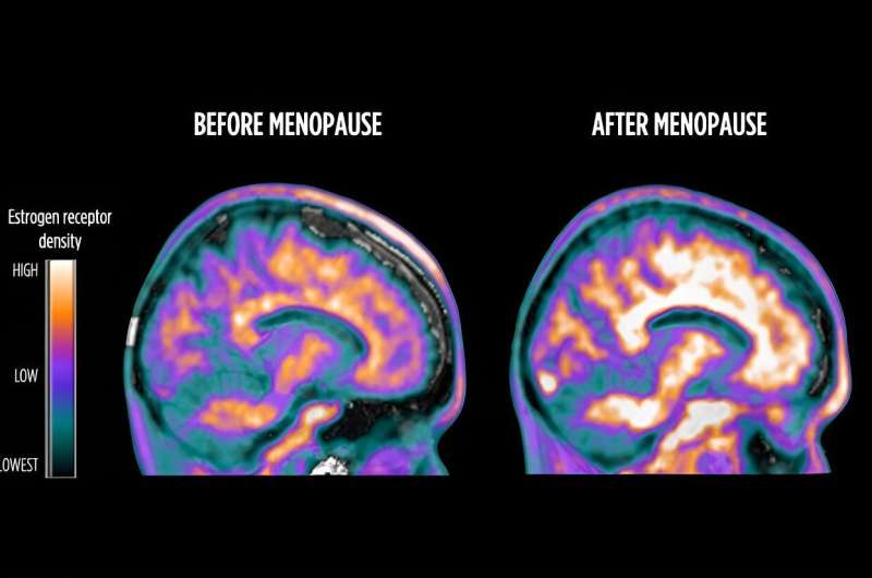 Scans show brain's estrogen activity changes during menopause