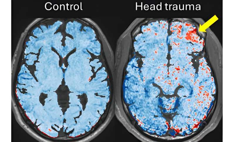 Scientists find repeated, small hits to head in football players can damage blood vessels in the brain