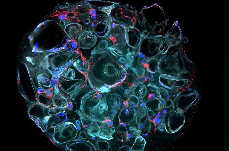 Scientists grow 'mini kidneys,' revealing new insights into metabolic defects and potential therapy for polycystic kidney disease