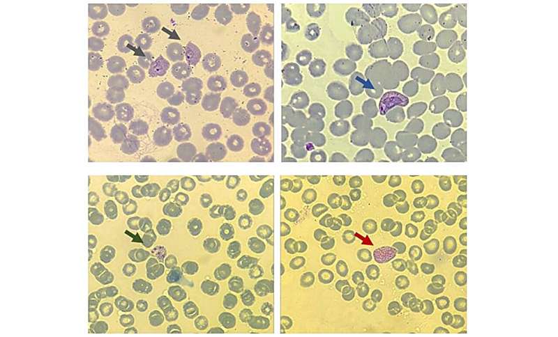 Scientists identify molecules associated with recurrence in blood samples from malaria patients