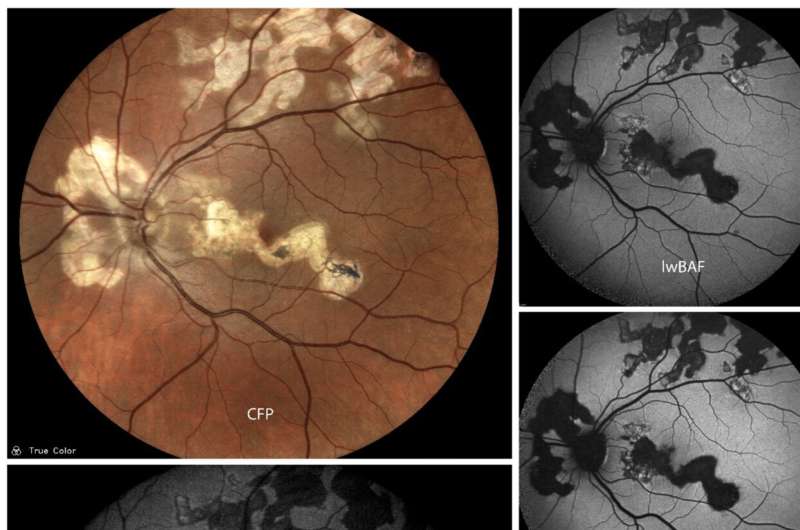 Simplified diagnosis of rare eye diseases: Uveitis experts provide an overview of an underestimated imaging technique