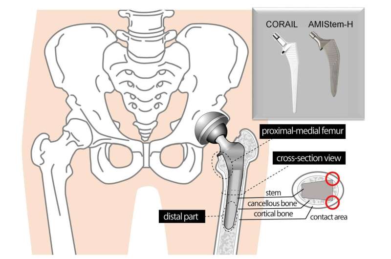 Staying hip to orthopedic advances: Comparing traditional and new hip replacement stems