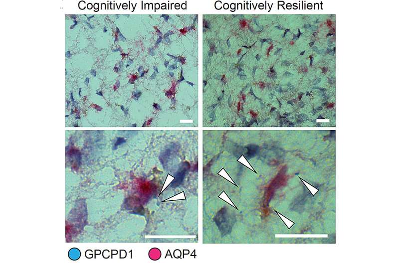 Study across multiple brain regions discerns Alzheimer's vulnerability and resilience factors