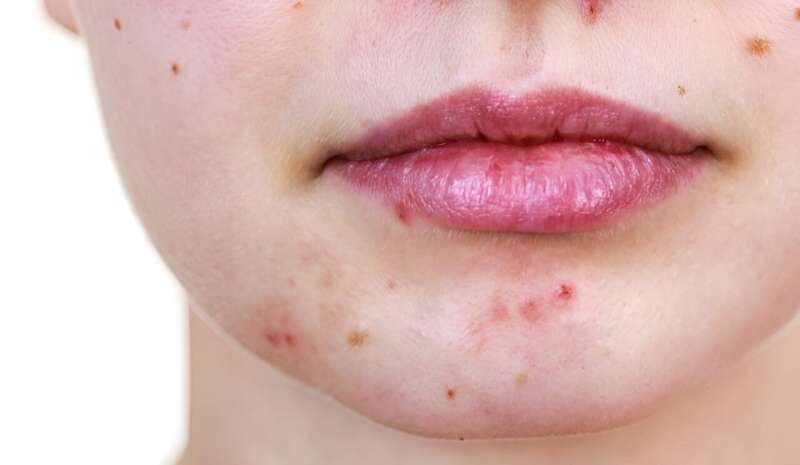 Study identifies factors that affect antibiotic prescribing for acne