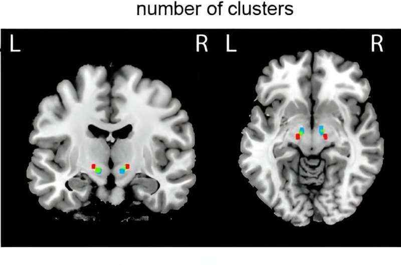 Study reveals brain mechanisms behind speech impairment in Parkinson’s