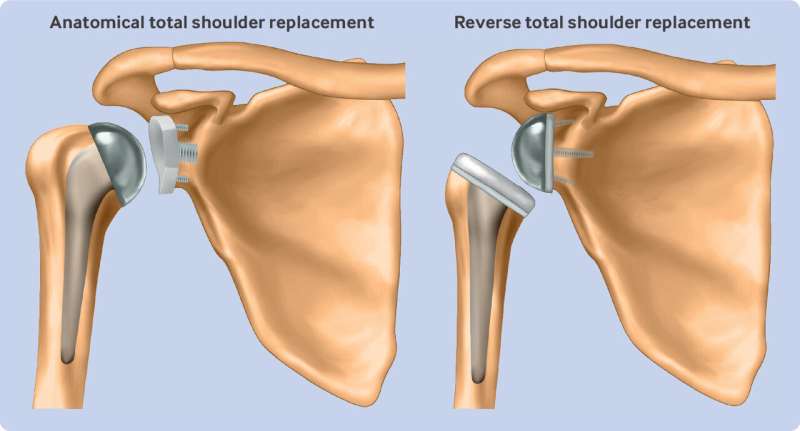 Study sheds light on the debate around two types of shoulder replacement surgery for osteoarthritis