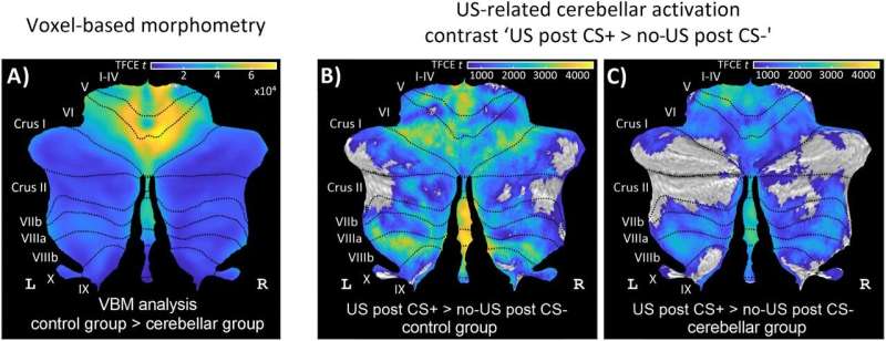 Study shows that the cerebellum is involved in processing emotions