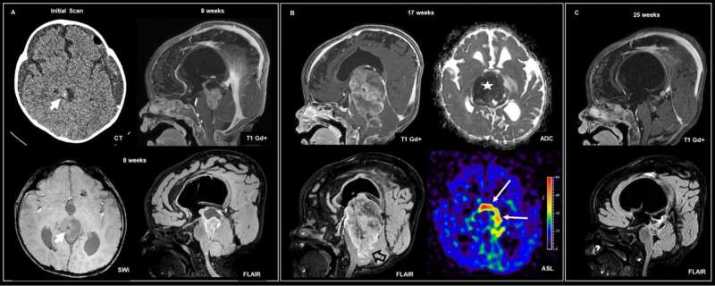 The use of new technologies expands understanding of brain tumors in children