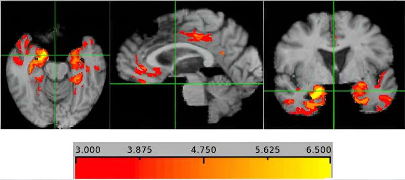 Thinning of brain region may signal dementia risk 5-10 years before symptoms