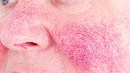 Tips to getting your rosacea under control