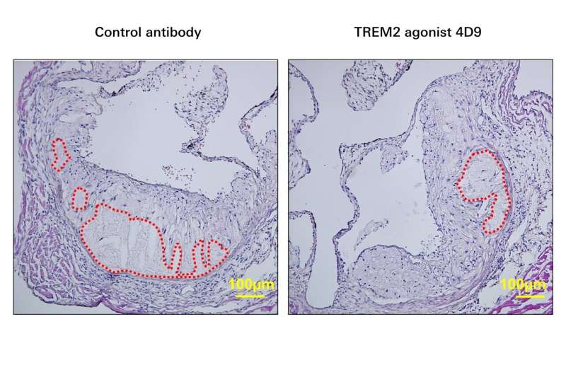 TREM2: a new player in atherosclerosis