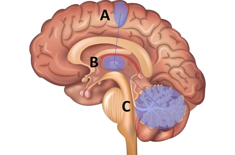 Trouble with trembling hands? The problem lies in the brain.