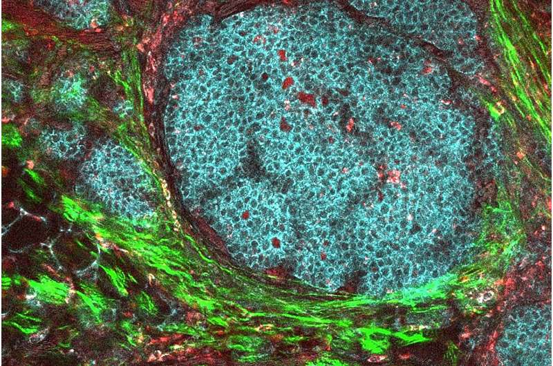 Turning a tumor's 'shield' into a weapon against itself