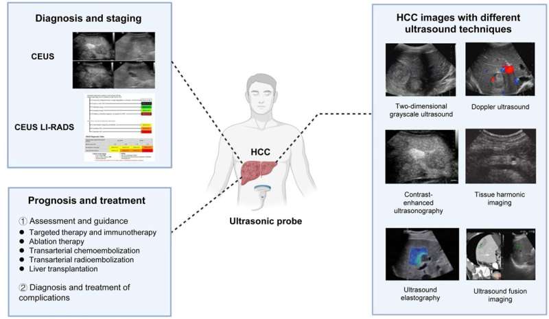 Ultrasonography of hepatocellular carcinoma: From diagnosis to prognosis