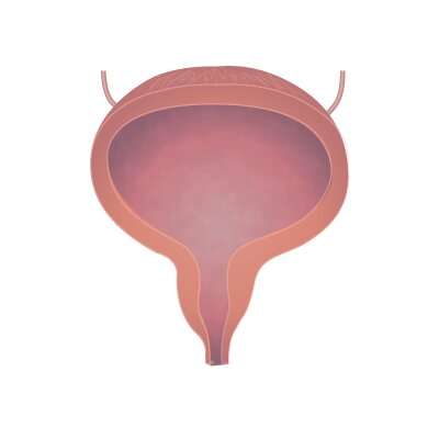 Understanding and preventing bladder cancer