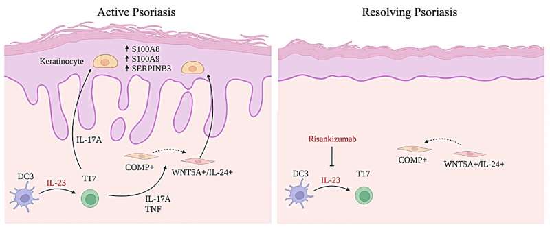 Understanding early effects of psoriasis drug offers potential for personalized treatment