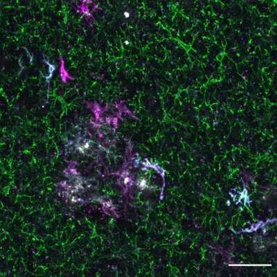 Understanding the role of microglia in Alzheimer's disease