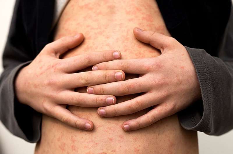 U.S. measles cases are already triple those of last year