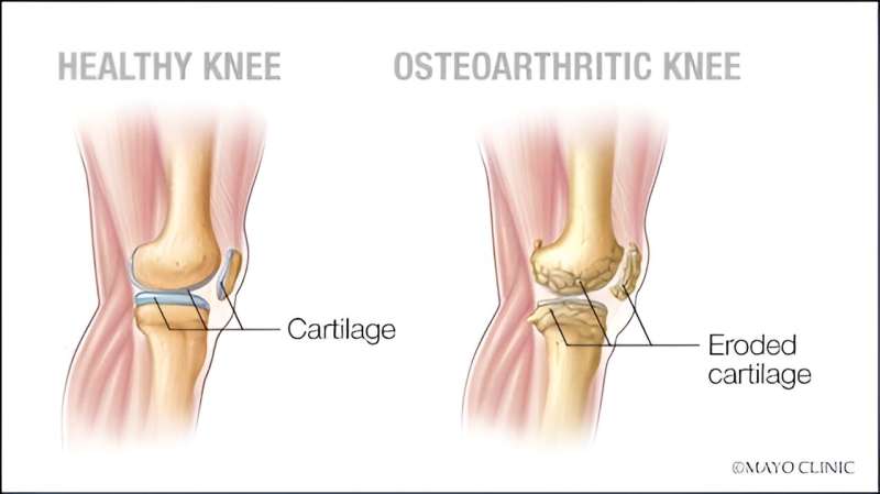 Video: Advances in knee replacement surgery