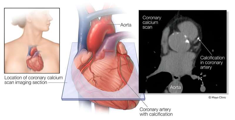 Video: How a coronary calcium scan assesses heart attack risk