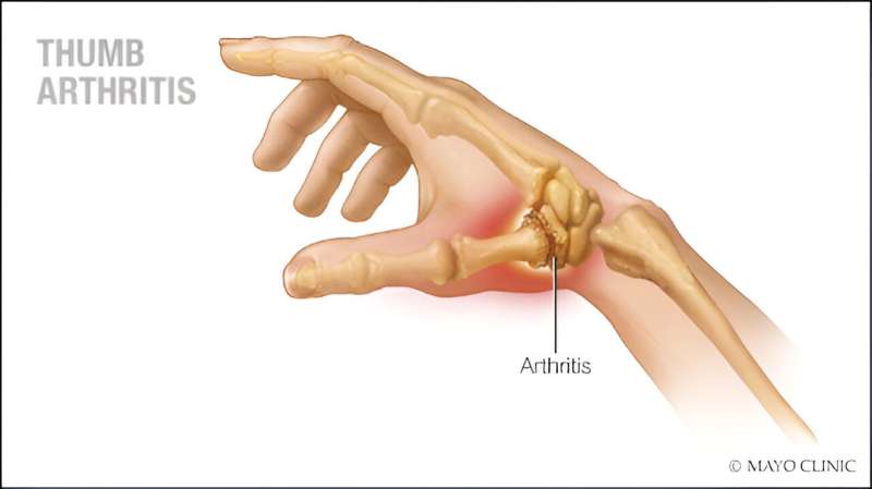 Video: Reducing thumb arthritis pain