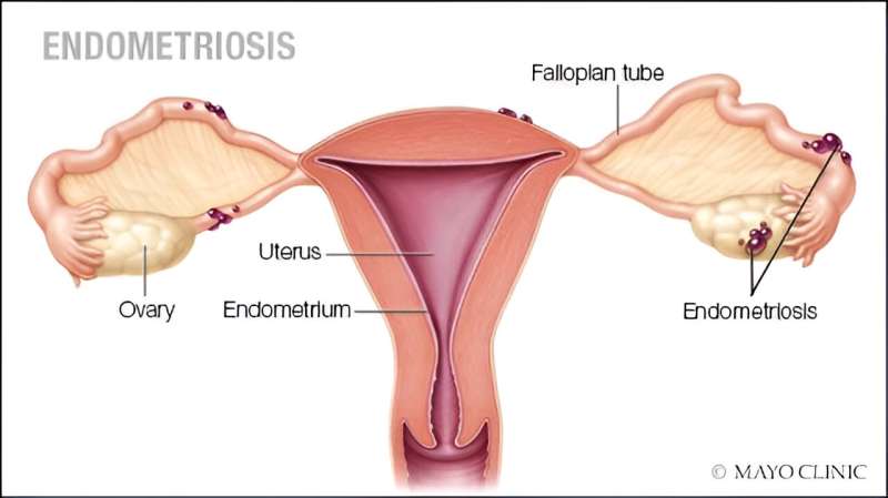 Video: When surgery for endometriosis is the answer