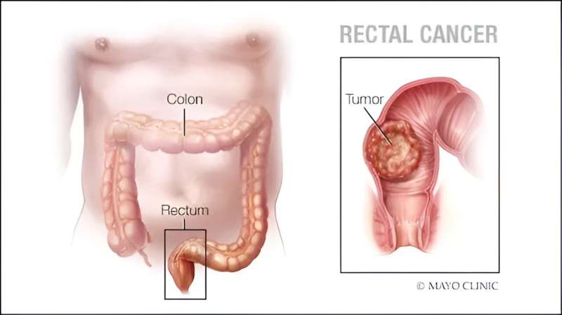 Warning signs of colorectal cancer in younger adults