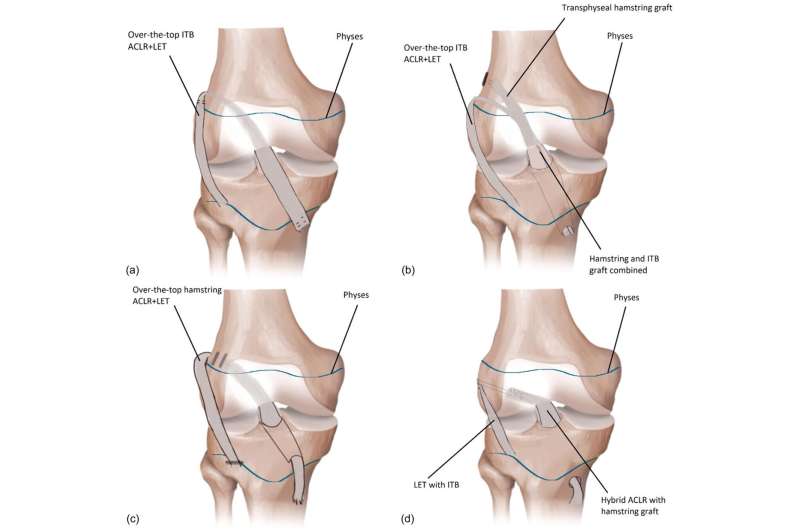 What are the trends and outcomes of anterior cruciate ligament injury treatments in children?