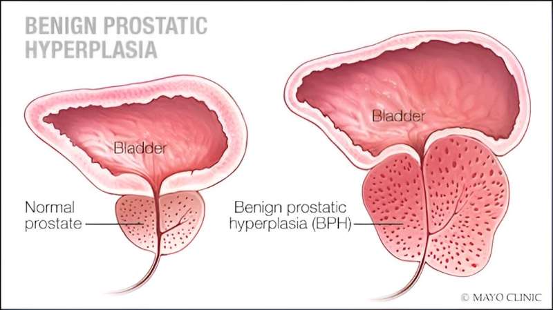 What does it mean to have an enlarged prostate?
