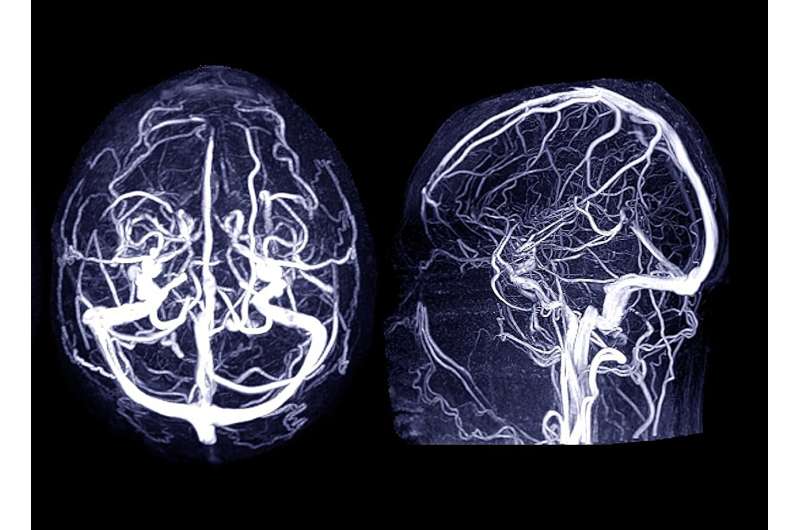 What is a cerebral aneurysm? what are the signs?
