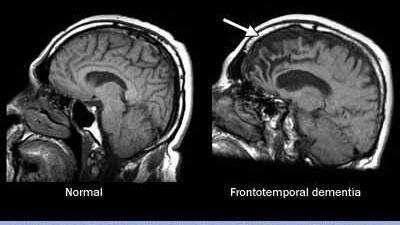 What is frontotemporal dementia?