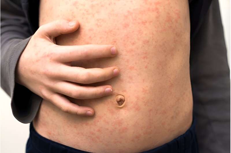 What is measles, and how can I shield myself &amp;amp; my family? 