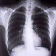 Life threatening breathing disorder of Rett syndrome prevented
