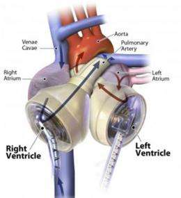 Arizona man is first to go home with a total artificial heart