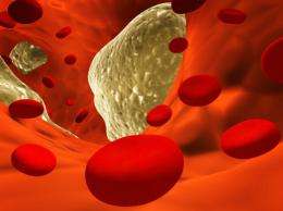 Treatment for stroke-related blood clots shows promise