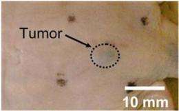 Advance toward earlier detection of melanoma
