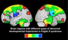 Brain changes associated with Fragile X take place before age 2