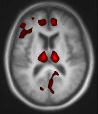 Brain scans show effects of Parkinson's drug