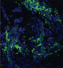 Brain tumors: Tissue stem cell turning into tumor stem cell