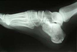 Calcaneus (heel bone) fracture X-ray