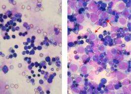 Cells of Aggressive Leukemia Hijack Normal Protein to Grow, According to Penn Study